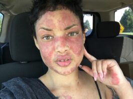 lupus, feminist, feminsm